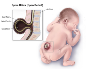 child with spina bifida